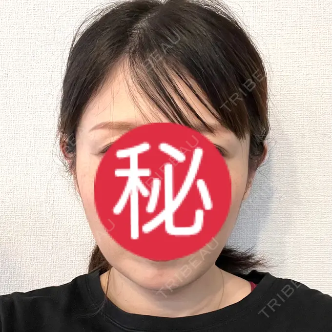 ボトックス（エラ・小顔） Code Beauty Clinic 名古屋院 AFTER メイン用