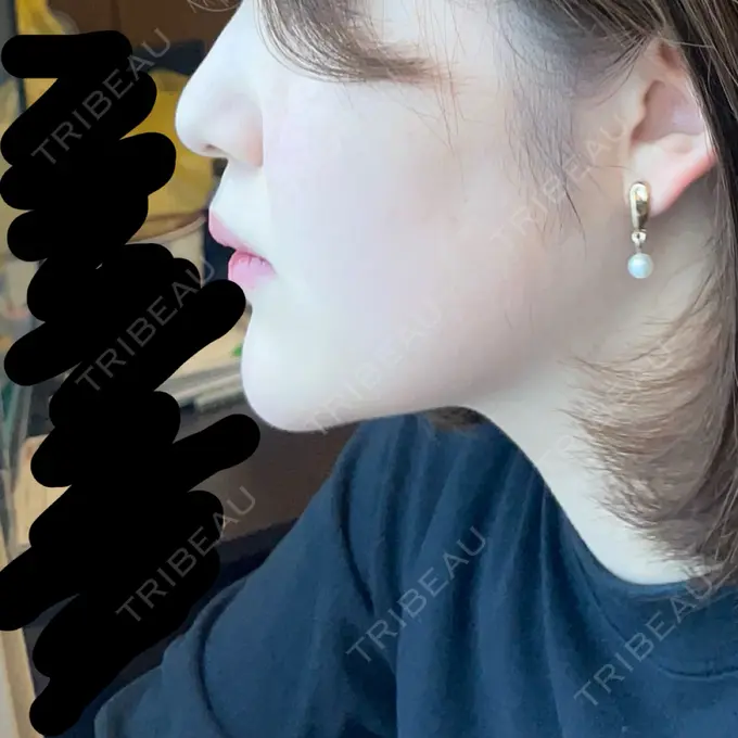 ヒアルロン酸注入（あご） / ボトックス（エラ・小顔） / 脂肪溶解注射（顔） TCB東京中央美容外科 京都四条院 AFTER メイン用