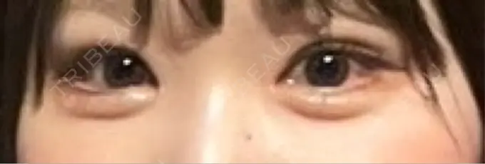 目頭切開 / クマ治療 / 目尻切開 / タレ目形成・グラマラスライン（切開） / 目尻靭帯移動 エターナル美容クリニック DAY 165 メイン用