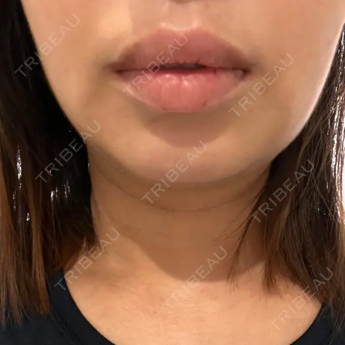 脂肪吸引（顔） / スネコス PRISM Beauty Clinic 町田院 DAY 3 メイン用