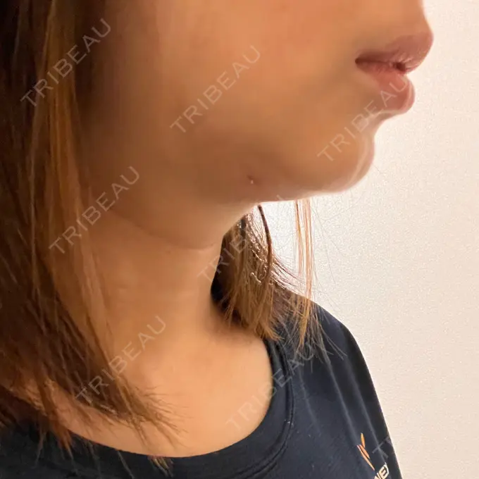 脂肪吸引（顔） / スネコス PRISM Beauty Clinic 町田院 DAY 3 メイン用