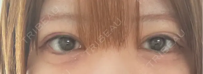 二重埋没 東京シンデレラ美容外科 大宮院 DAY 10 メイン用