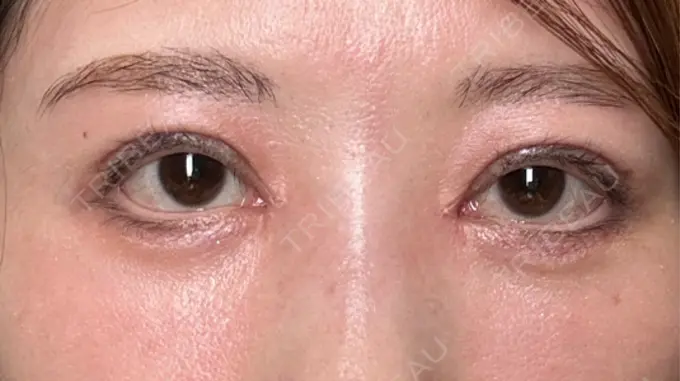 二重埋没 / 目頭切開 / クマ治療 ROOTS Clinic DAY 12 メイン用