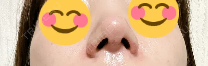 鼻尖形成（切開） / 軟骨移植 / 鼻翼挙上 / 鼻修正 / その他（鼻） 東京シンデレラ美容外科 大宮院 DAY 7 メイン用