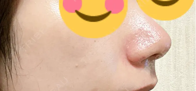 鼻尖形成（切開） / 軟骨移植 / 鼻翼挙上 / 鼻修正 / その他（鼻） 東京シンデレラ美容外科 大宮院 DAY 7 メイン用