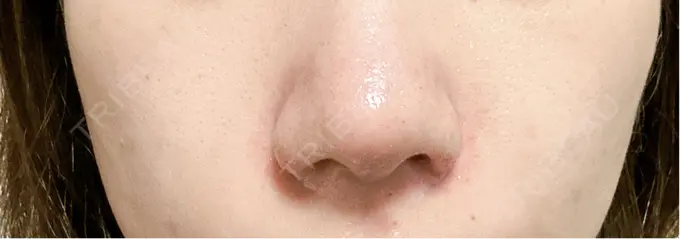 鼻尖形成（切開） / 軟骨移植 / 鼻翼挙上 / 鼻修正 / その他（鼻） 東京シンデレラ美容外科 大宮院 DAY 7 メイン用