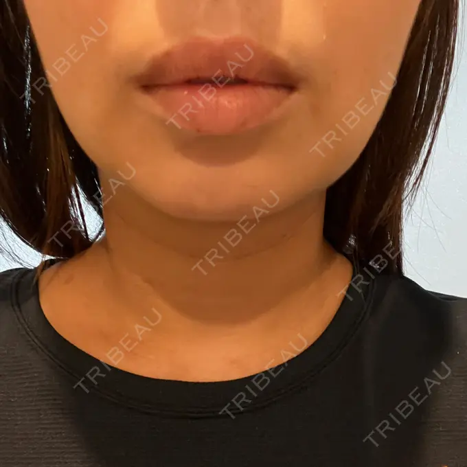 脂肪吸引（顔） / スネコス PRISM Beauty Clinic 町田院 DAY 4 メイン用