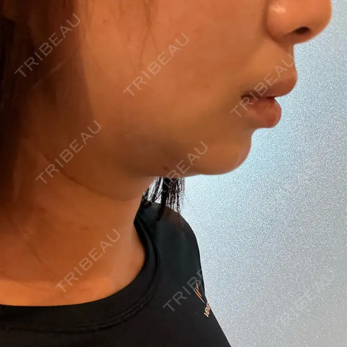 脂肪吸引（顔） / スネコス PRISM Beauty Clinic 町田院 DAY 4 メイン用