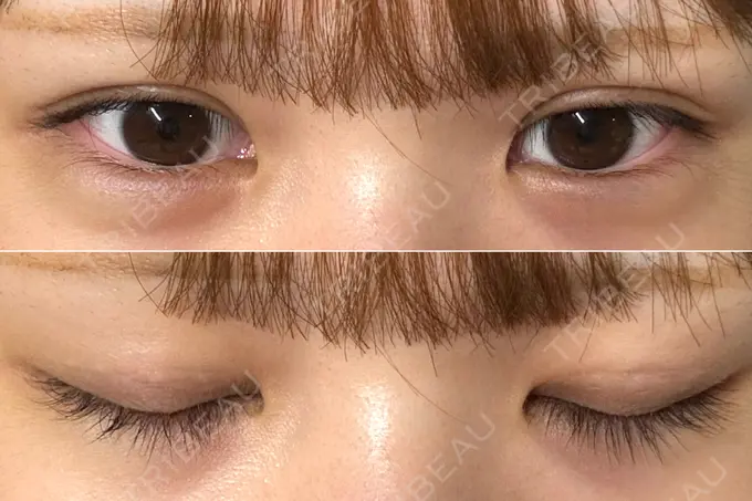 二重埋没 / 上まぶたの脂肪取り THE FIRST CLINIC 多摩センター院 DAY 15 メイン用