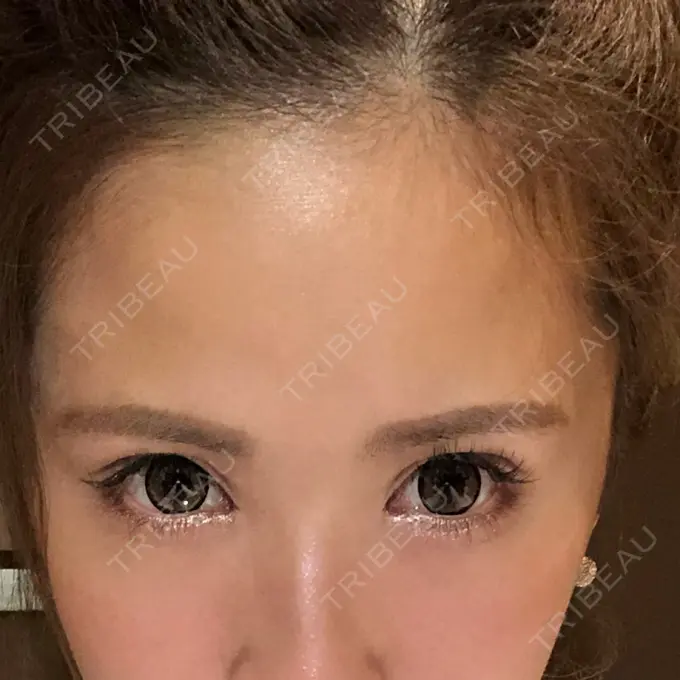 目尻切開 / タレ目形成・グラマラスライン（切開） 品川美容外科 横浜院（※品川スキンクリニック提携） AFTER メイン用