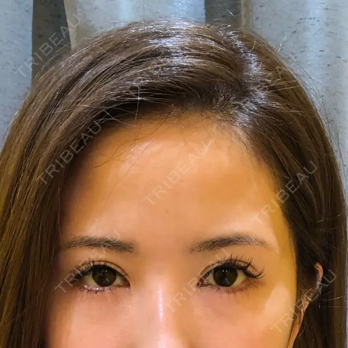 目尻切開 / タレ目形成・グラマラスライン（切開） 品川美容外科 横浜院（※品川スキンクリニック提携） DAY 78 メイン用