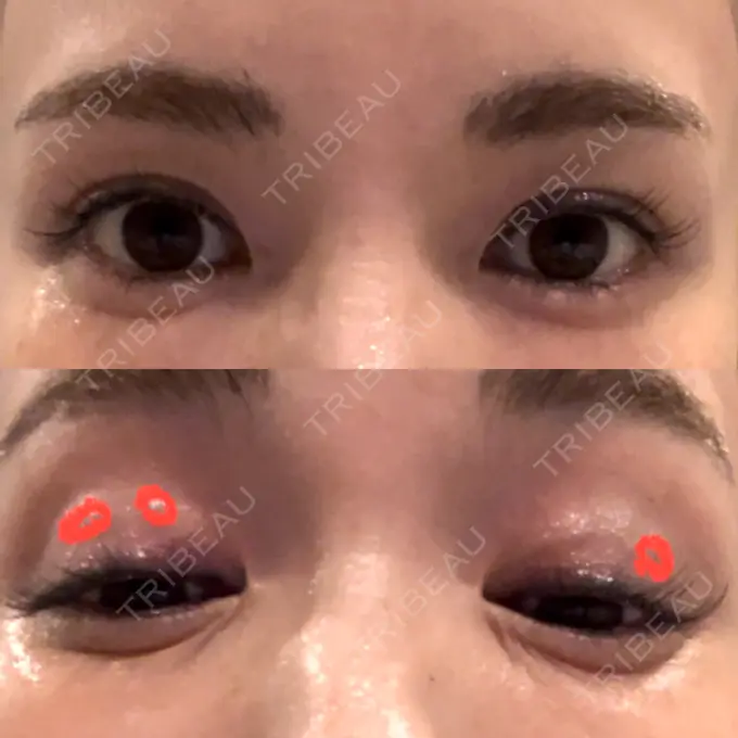 二重埋没 吉祥寺アイビークリニック DAY 7 メイン用