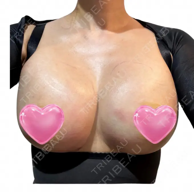 脂肪吸引（二の腕） / 豊胸（脂肪注入） / 脂肪吸引（腰） / 脂肪吸引（肩） Mods Clinic（モッズクリニック） 名古屋院 DAY 0 メイン用