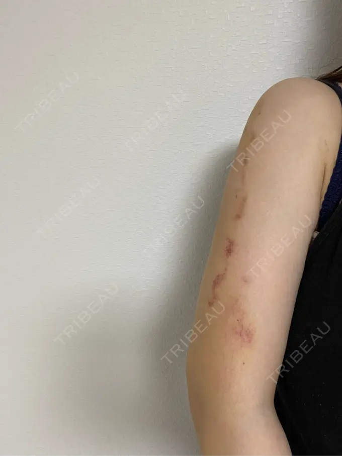 糸リフト / バッカルファット除去 / 脂肪吸引（顔） / 脂肪吸引（二の腕） 湘南美容クリニック 京都院 DAY 13 メイン用