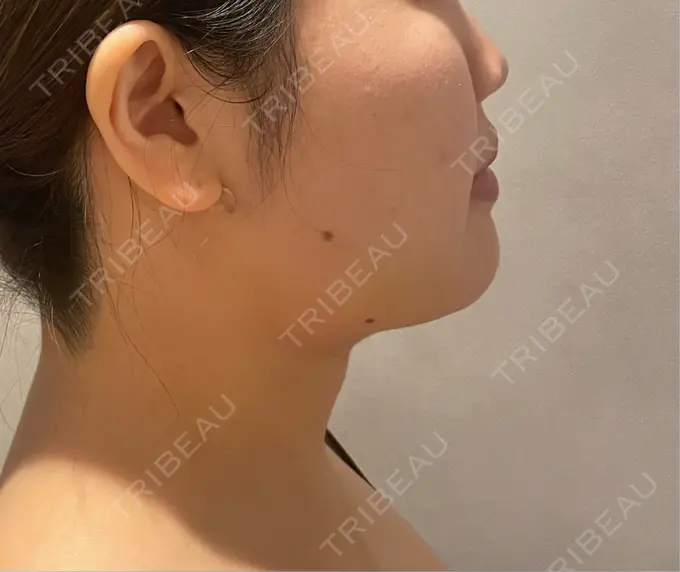 糸リフト / バッカルファット除去 / 脂肪吸引（顔） / 脂肪吸引（二の腕） 湘南美容クリニック 京都院 DAY 13 メイン用