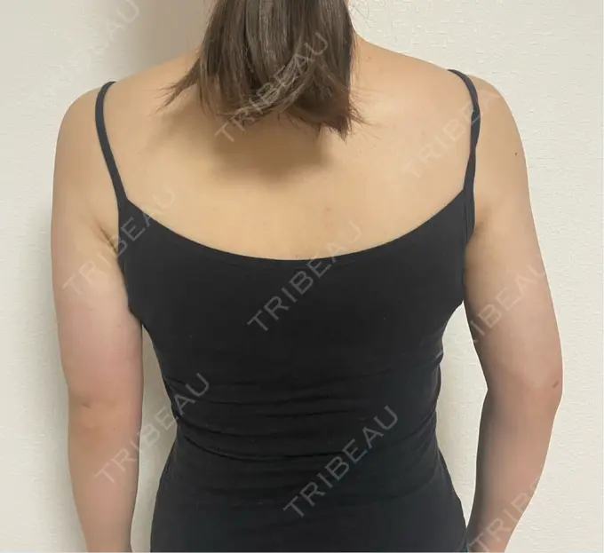 糸リフト / バッカルファット除去 / 脂肪吸引（顔） / 脂肪吸引（二の腕） 湘南美容クリニック 京都院 DAY 30 メイン用