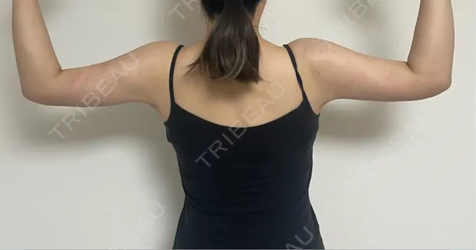 糸リフト / バッカルファット除去 / 脂肪吸引（顔） / 脂肪吸引（二の腕） 湘南美容クリニック 京都院 DAY 30 メイン用