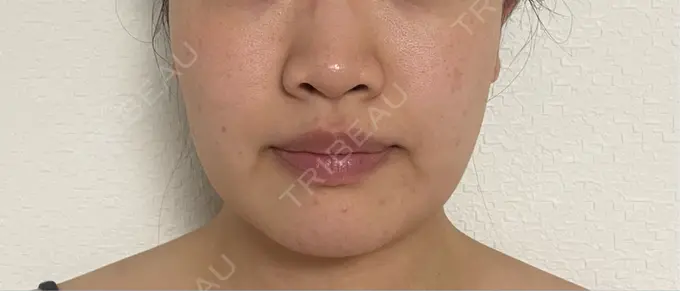 糸リフト / バッカルファット除去 / 脂肪吸引（顔） / 脂肪吸引（二の腕） 湘南美容クリニック 京都院 DAY 30 メイン用