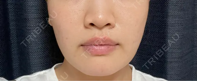 糸リフト / バッカルファット除去 / 脂肪吸引（顔） / 脂肪吸引（二の腕） 湘南美容クリニック 京都院 DAY 91 メイン用