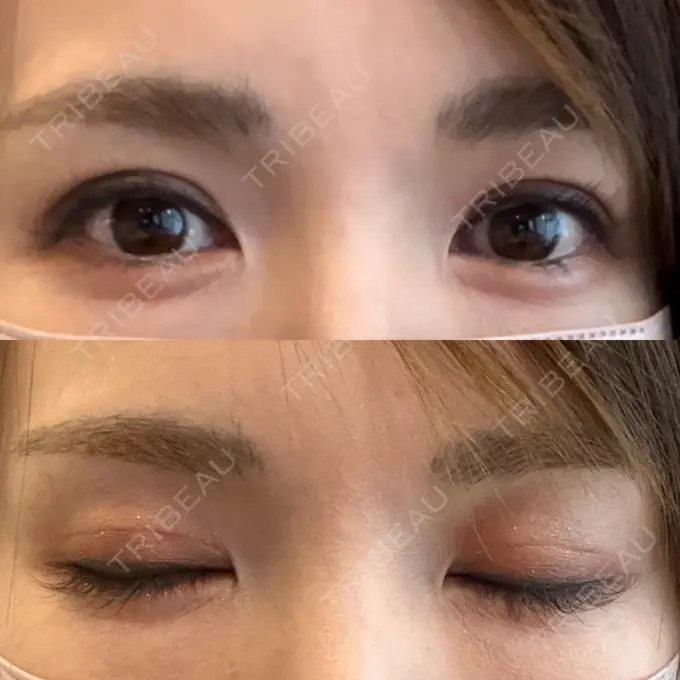 二重埋没 吉祥寺アイビークリニック DAY 8 メイン用