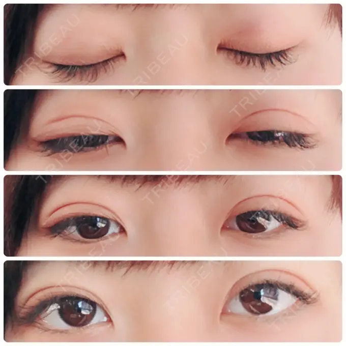 二重埋没 湘南美容クリニック 長野院 DAY 2 メイン用