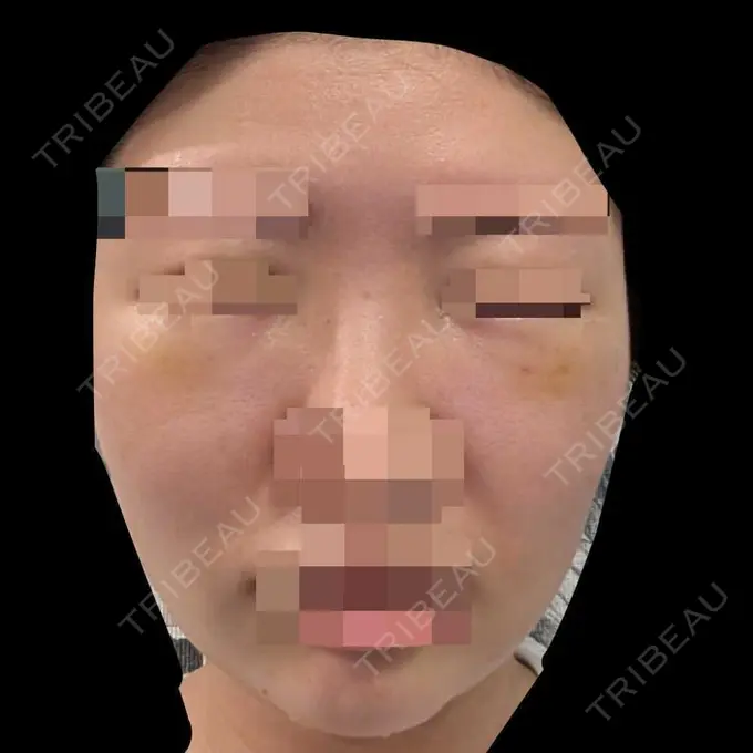 糸リフト / クマ治療 / 脂肪吸引（顔） / 脂肪注入（目の下） 東京ココセランクリニック DAY 5 メイン用