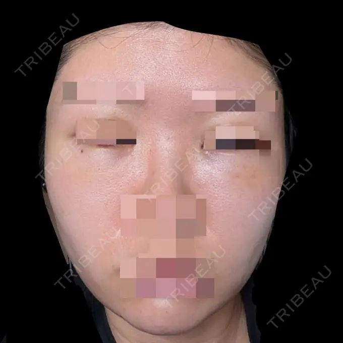 糸リフト / クマ治療 / 脂肪吸引（顔） / 脂肪注入（目の下） 東京ココセランクリニック DAY 7 メイン用