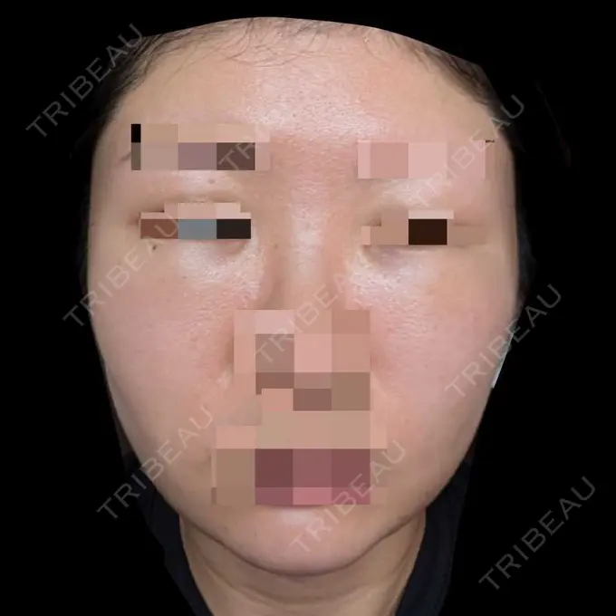 糸リフト / クマ治療 / 脂肪吸引（顔） / 脂肪注入（目の下） 東京ココセランクリニック DAY 10 メイン用