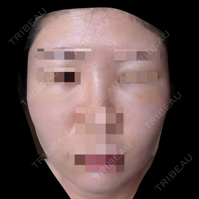 糸リフト / クマ治療 / 脂肪吸引（顔） / 脂肪注入（目の下） 東京ココセランクリニック DAY 8 メイン用