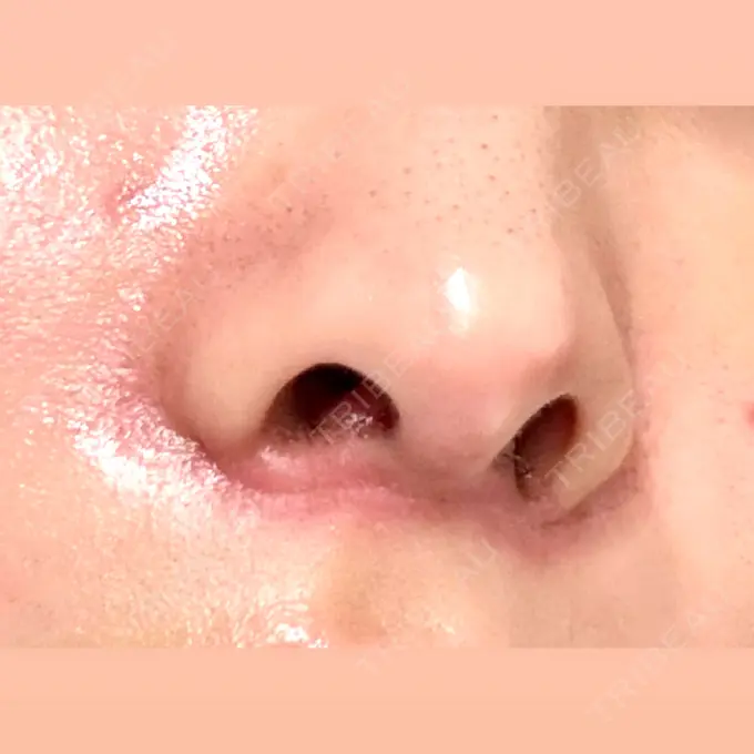 人中短縮 / 目尻切開 / ヒアルロン酸注入（鼻翼基部） 新宿ラクル美容外科クリニック 六本木院 DAY 10 メイン用