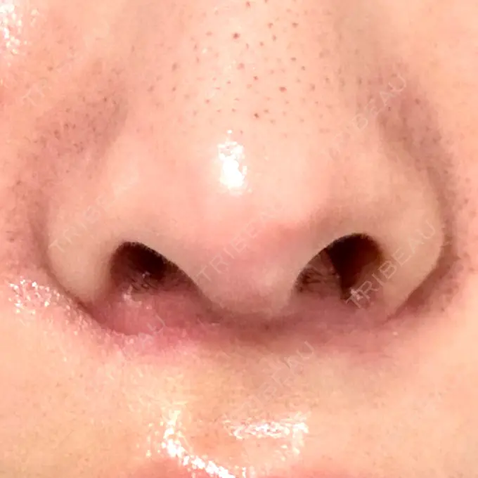 人中短縮 / 目尻切開 / ヒアルロン酸注入（鼻翼基部） 新宿ラクル美容外科クリニック 六本木院 DAY 10 メイン用