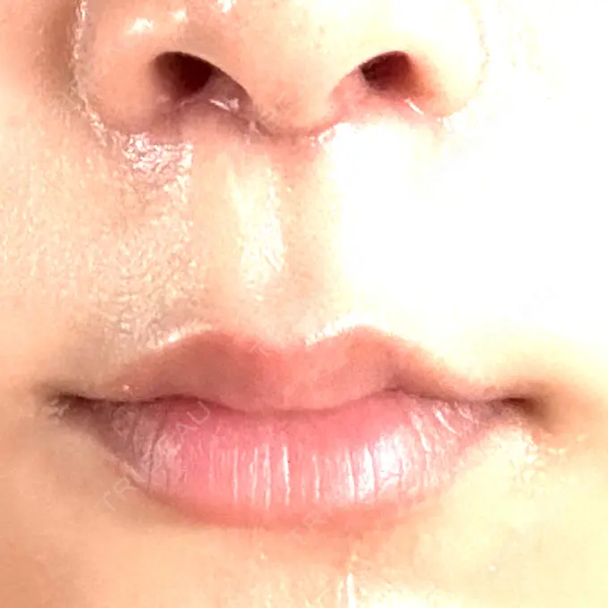 小鼻縮小（切開） / 人中短縮 eクリニック 東京院 AFTER メイン用