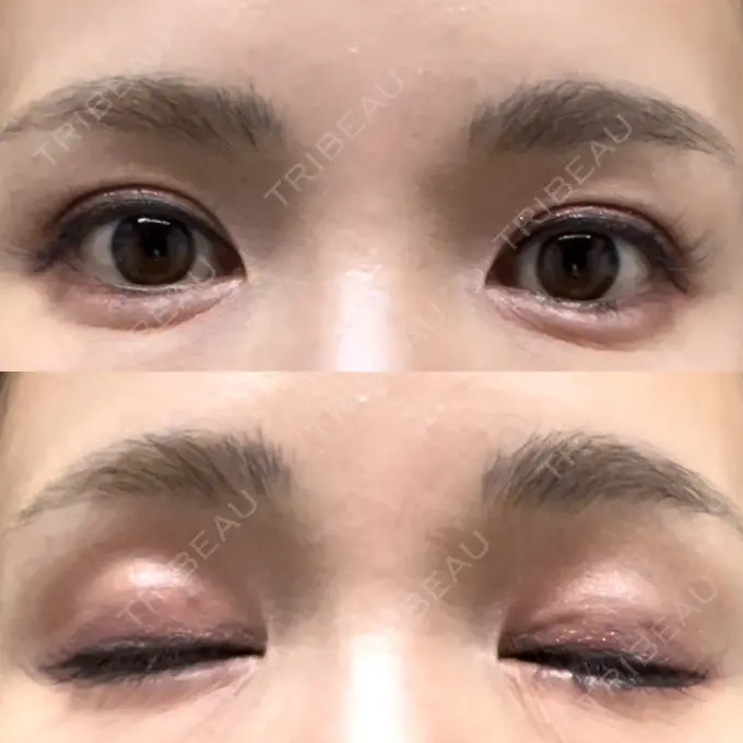 二重埋没 吉祥寺アイビークリニック DAY 9 メイン用