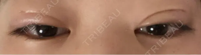 二重埋没 / 上まぶたの脂肪取り アリエル美容クリニック 郡山院 DAY 21 メイン用