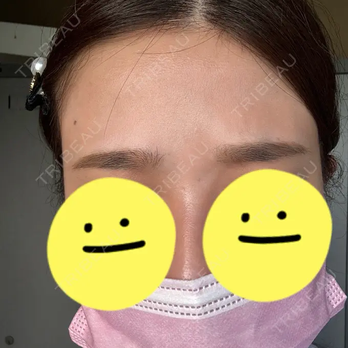 ボトックス（エラ・小顔） / ボトックス（眉間） / ボトックス（額） TCB東京中央美容外科 静岡院 DAY 3 メイン用