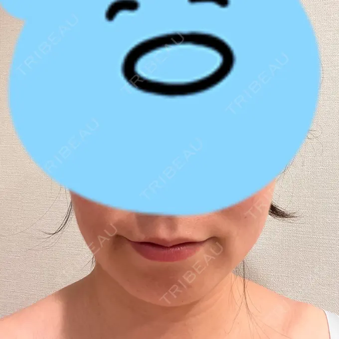 脂肪溶解注射（顔） 表参道ウィズ・クリニック DAY 14 メイン用