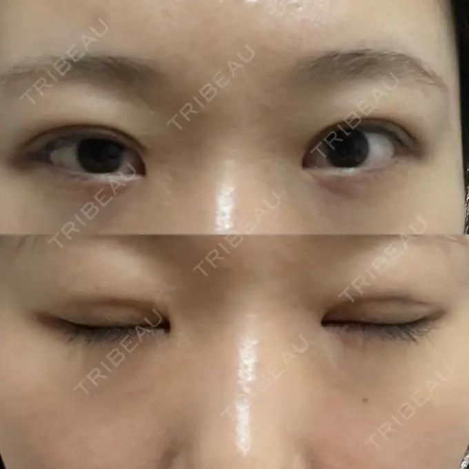 二重埋没 / クマ治療 / ボトックス（エラ・小顔） / ヒアルロン酸注入（額） / ボトックス（肩） / その他（目元） TCB東京中央美容外科 京都四条院 DAY 15 メイン用