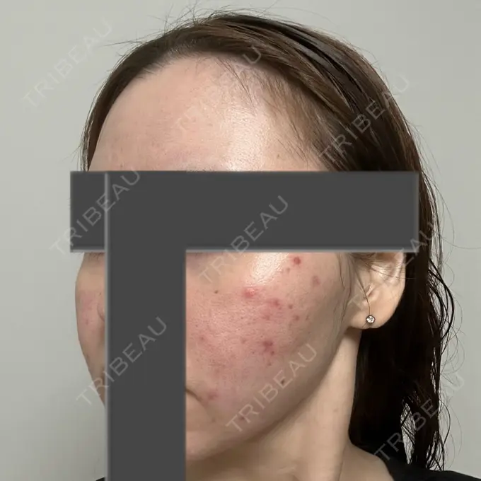 ニードルRF（ポテンツァなど） 東京美容外科 池袋院 DAY 26 メイン用