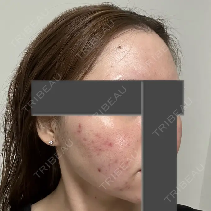 ニードルRF（ポテンツァなど） 東京美容外科 池袋院 DAY 26 メイン用