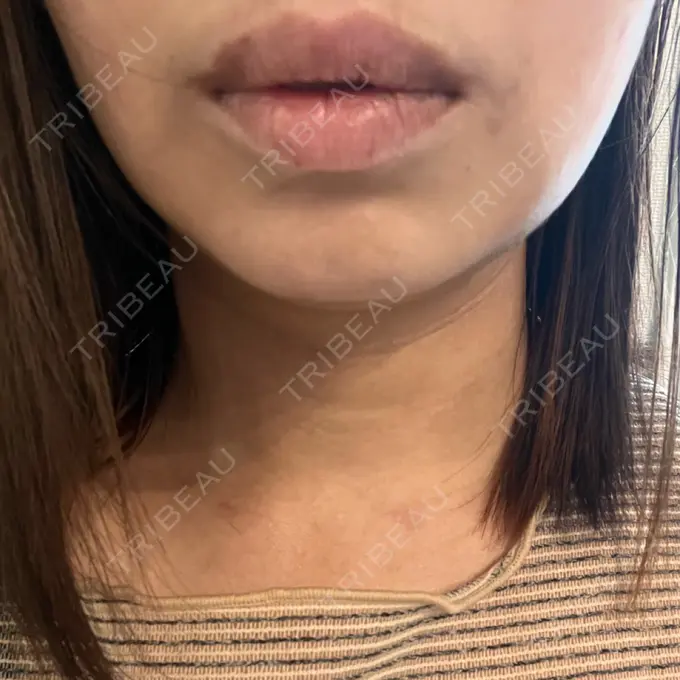 脂肪吸引（顔） / スネコス PRISM Beauty Clinic 町田院 AFTER メイン用