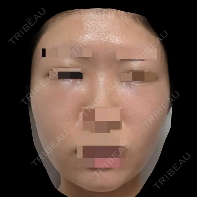 糸リフト / クマ治療 / 脂肪吸引（顔） / 脂肪注入（目の下） 東京ココセランクリニック DAY 12 メイン用