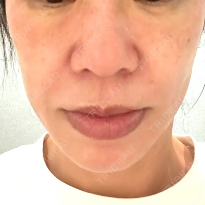 肌ヒアルロン酸注入（たるみ・シワ改善） / ピコレーザートーニング（美白・肝斑） ルラ美容クリニック 仙台院 / ルラスキンクリニック 仙台院 AFTER メイン用