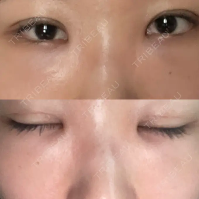 二重埋没 / クマ治療 / ボトックス（エラ・小顔） / ヒアルロン酸注入（額） / ボトックス（肩） / その他（目元） TCB東京中央美容外科 京都四条院 DAY 17 メイン用