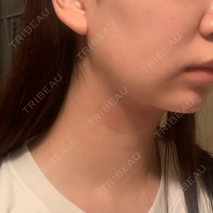 ボトックス（エラ・小顔） ドクター松井クリニック 新宿 AFTER メイン用