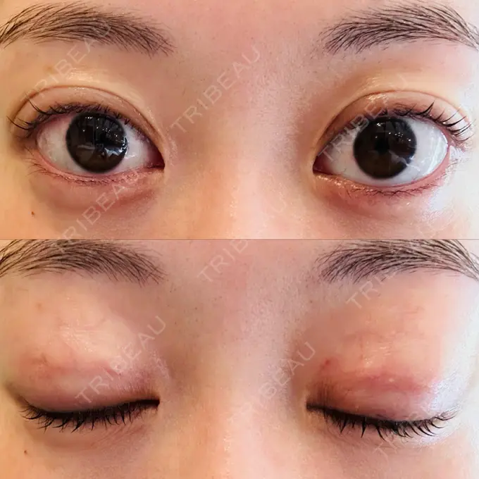 二重埋没 水の森美容クリニック 大阪梅田院 DAY 8 メイン用