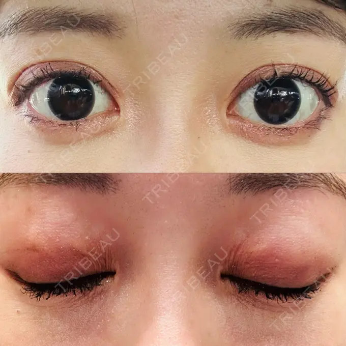 二重埋没 水の森美容クリニック 大阪梅田院 DAY 7 メイン用