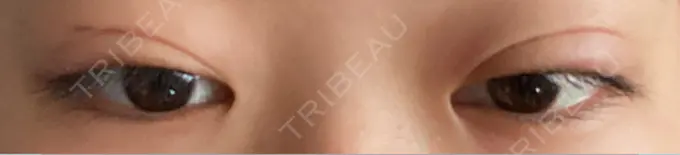 二重埋没 / 上まぶたの脂肪取り アリエル美容クリニック 郡山院 AFTER メイン用