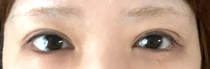 二重埋没 東京シンデレラ美容外科 大宮院 DAY 14 メイン用