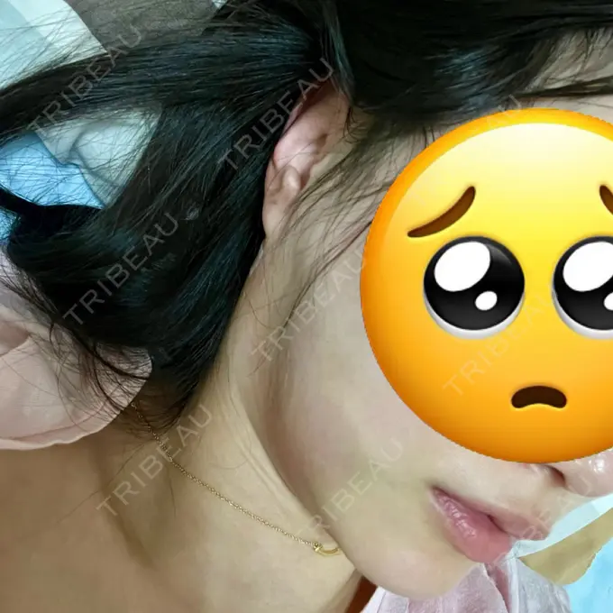 糸リフト / 脂肪吸引（顔） / ジョールファット除去 RIVER CLINIC（リバークリニック） DAY 1 メイン用