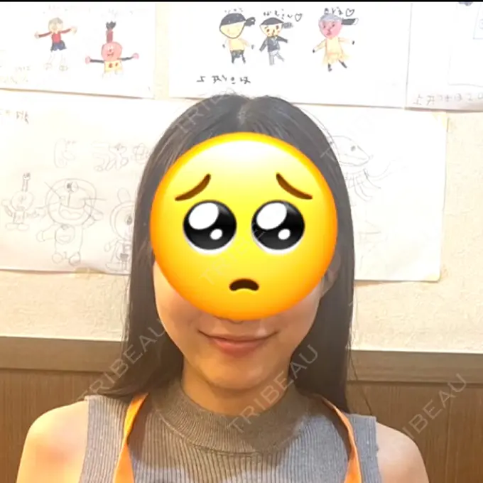 糸リフト / 脂肪吸引（顔） / ジョールファット除去 RIVER CLINIC（リバークリニック） AFTER メイン用